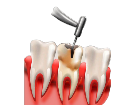 Partially Erupted Tooth Extraction Mysore